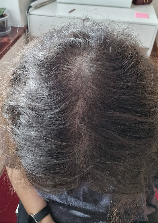 After photo showing hair growth results