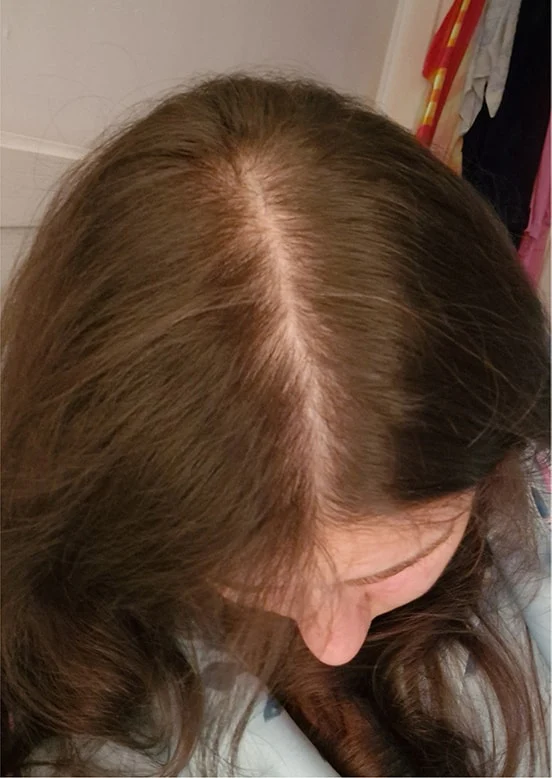 Before photo showing hair loss